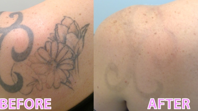 My Tattoo Removal Story