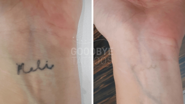 Running Through Reasons For Laser Tattoo Removal