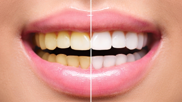 Shining Smiles: Unlock Your Brightest White with Teeth Whitening